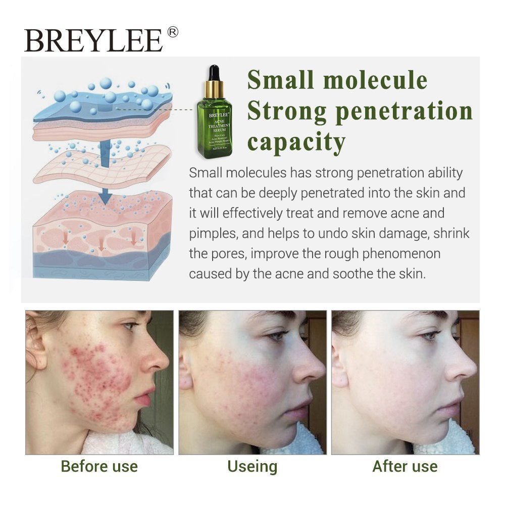Acne Treatment Serum