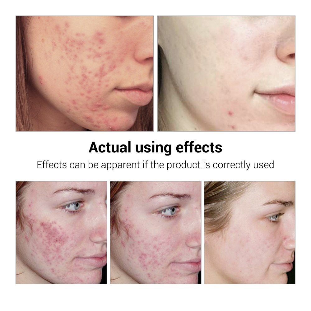 Acne Treatment Serum