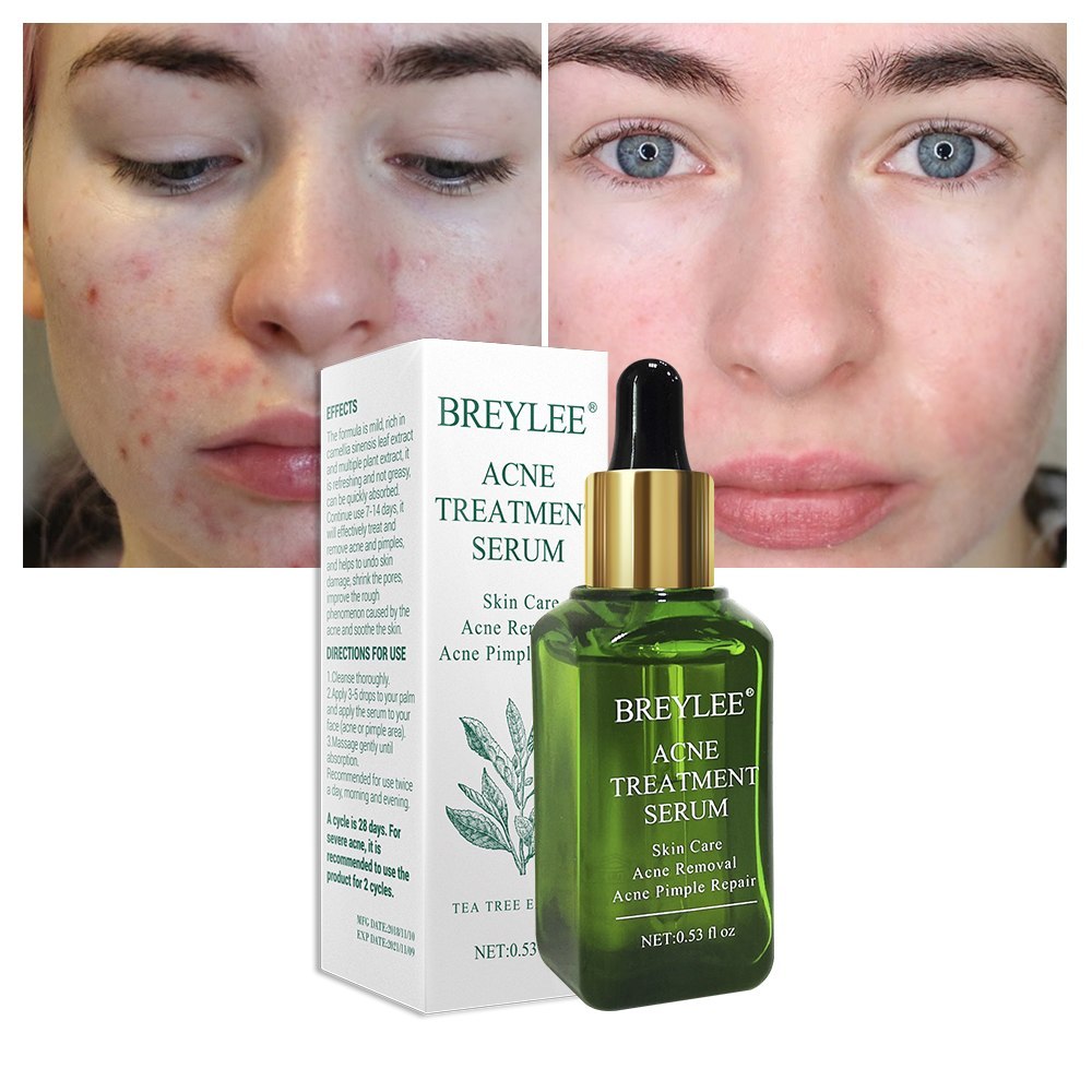Acne Treatment Serum